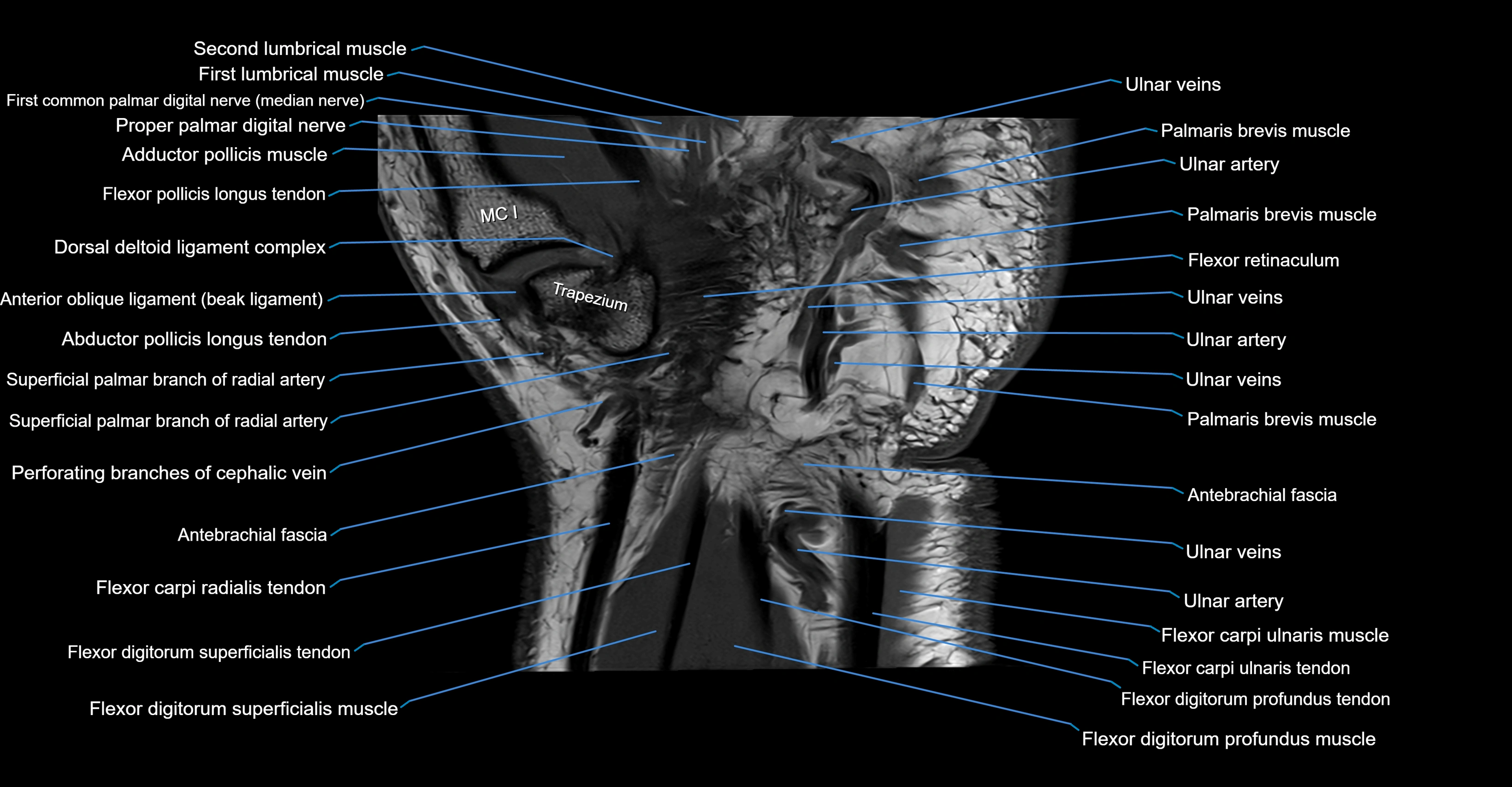MRI wrist coronal cross sectional anatomy 3T  radiology  image-img-00001-00022.webp